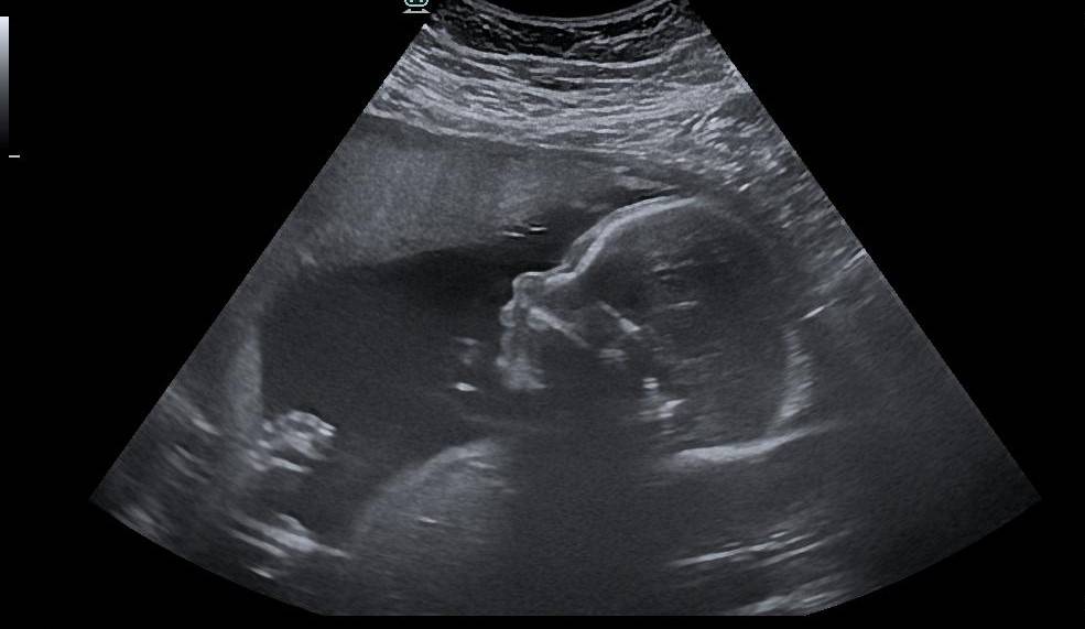 Echographie obstétricale de la CROISSANCE du fœtus chez la femme